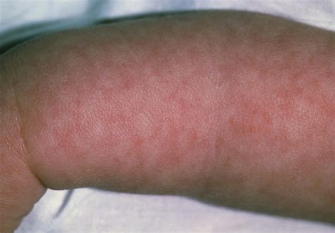 viral meningitis rash picture